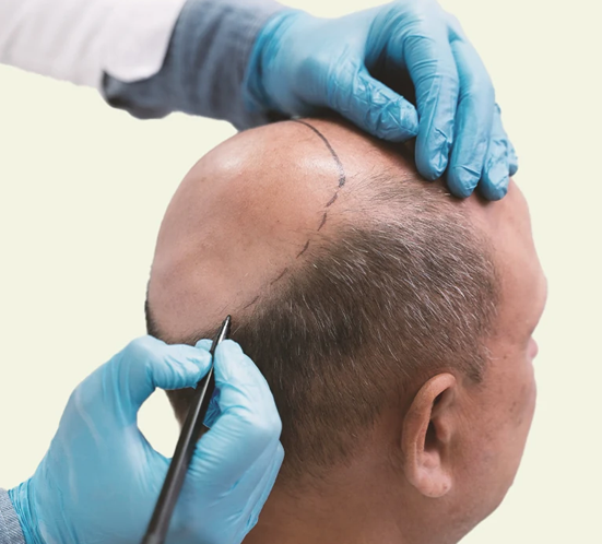  Restore your hair naturally with Bio FUE hair transplant in Thudiyalur. Achieve healthy, lasting results!