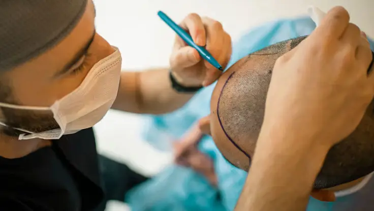 Doctor is wearing a mask & marking the patient's head with a marker for hair transplant  treatment.