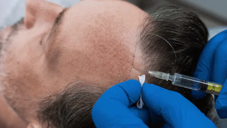 A man is seated, as a trichologist injects a man's head for platelet-rich plasma hair treatment.