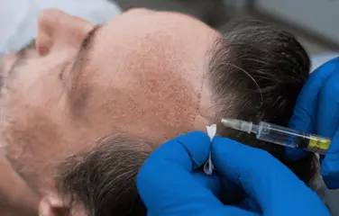 A man in a hair care clinic receiving help from dermatologists during a hair transplant treatment.